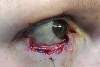 mohs chirurgie van het ooglid voor de behandeling van basaalcelcarcinoom 